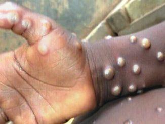 Expert Discovers Monkeypox In Same-Sex Practicing Male In Nigeria