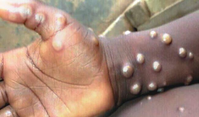 Expert Discovers Monkeypox In Same-Sex Practicing Male In Nigeria