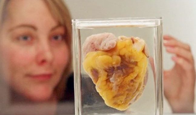 Woman Sees Her Own Heart On Display at Museum, 16 Years After Transplant Surgery
