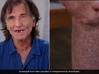 Man Struggling with "Crocodile-Like Skin" Shares Painful Journey: Clothes Cause Agony